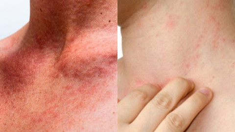 Güneş alerjisi ve belirtileri