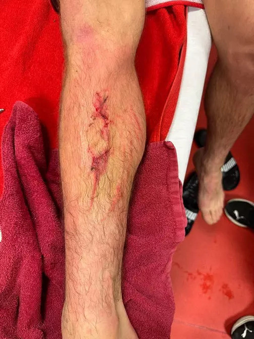 Galatasaray'dan VAR isyanı! Yıldız futbolcunun bacağı kanlar içinde kaldı - Resim : 3