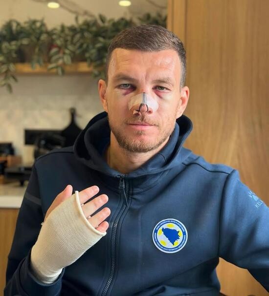 Edin Dzeko sakatlığı hakkında son durumu paylaştı: "Ya hepsi ya hiç" - Resim : 2