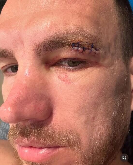Edin Dzeko sakatlığı hakkında son durumu paylaştı: "Ya hepsi ya hiç"