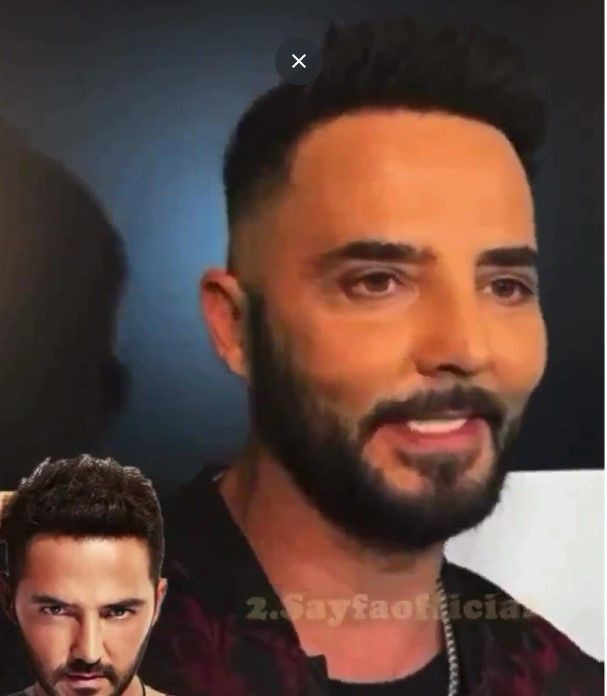 Gökhan Özen'in yüzündeki değişim sosyal medya kullanıcılarının dilinde! - Fotoğraf: 4