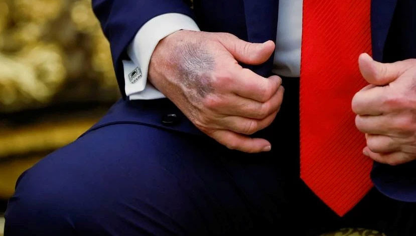 Merak konusu olmuştu! Trump elindeki morluklarının sebebini açıkladı