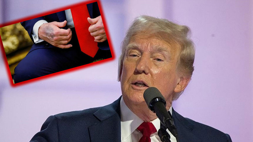 Merak konusu olmuştu! Trump elindeki morluklarının sebebini açıkladı