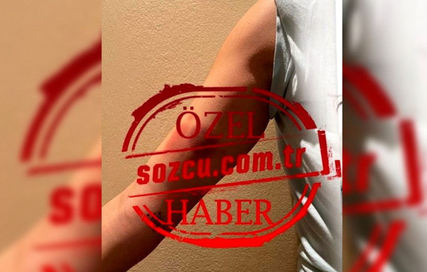 Ozan Güven'den şiddet gördüğünü söyleyen Deniz Bulutsuz'un vücudundaki morlukların görüntüsü ortaya çıktı - Resim : 2