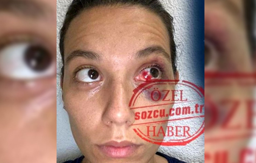 Ozan Güven'den şiddet gördüğünü söyleyen Deniz Bulutsuz'un vücudundaki morlukların görüntüsü ortaya çıktı - Resim : 3