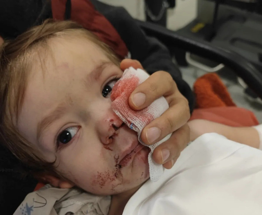 Pitbull cinsi köpeğin saldırısına uğrayan çocuğun yüzü paramparça oldu - Resim : 2