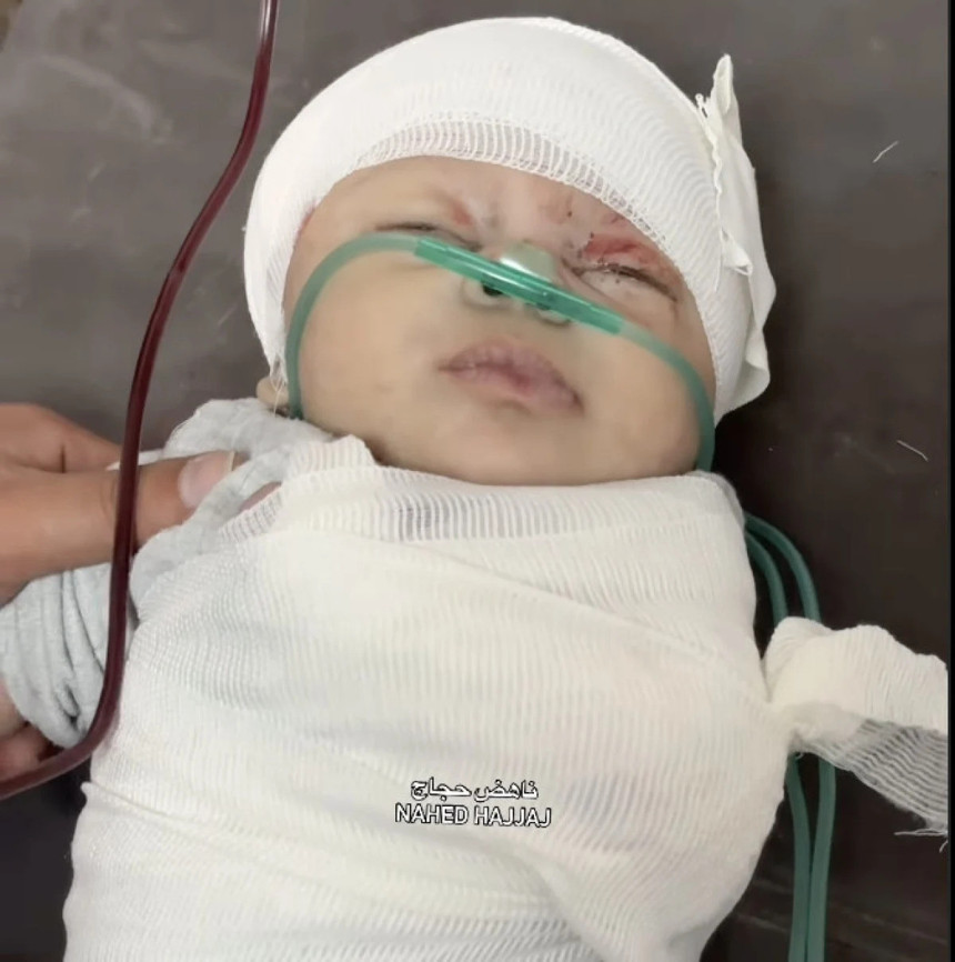 Bebek Katili İsrail! Saldırıda kolu kopan Gazzeli minik bebeğin son hali yürekleri burktu! - Resim : 2