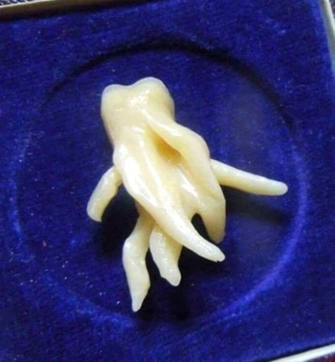 6 köklü diş dişçilerin kabusu oldu! - Sayfa 15