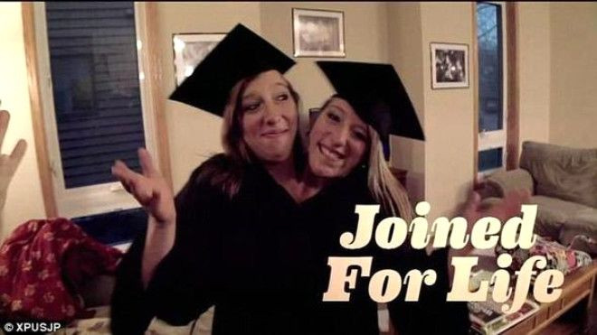 Doktorlar 'Yaşayamaz' demişti,  27 yaşındalar! - Sayfa 9