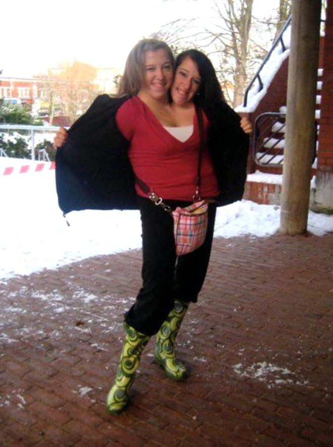 Doktorlar 'Yaşayamaz' demişti,  27 yaşındalar! - Sayfa 7