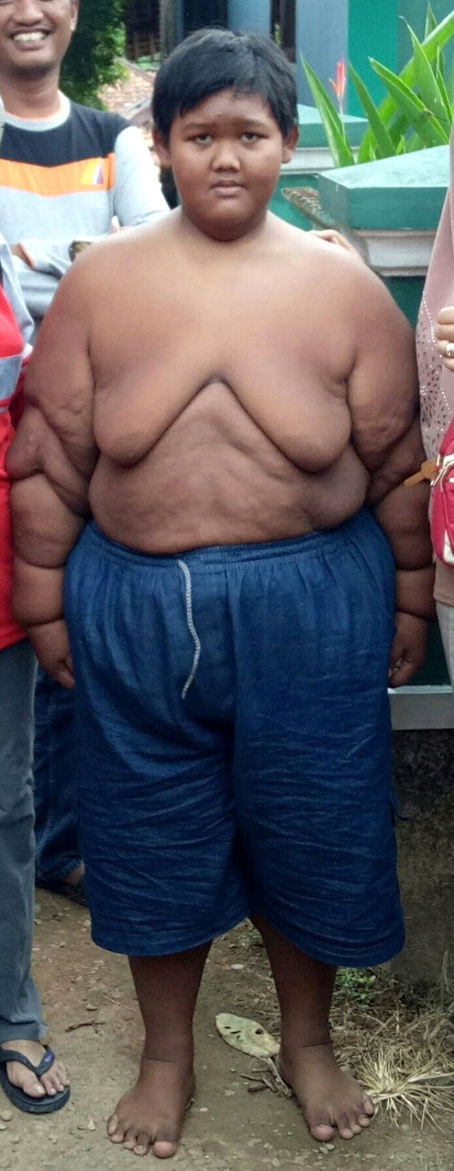 Dünyanın en şişman çocuğu 83 kilo verince... - Sayfa 7