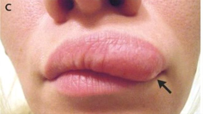 Yüzündeki şişliklerin içinden bakın ne çıktı! - Sayfa 5