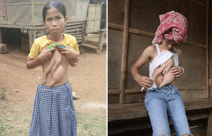 Vücudunda ikizini taşıyor! - Sayfa 7