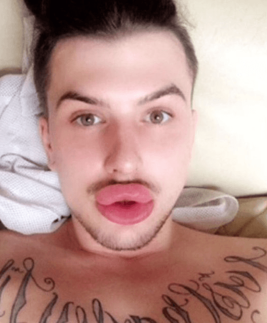 Dudakları patlama noktasına geldi! - Sayfa 5