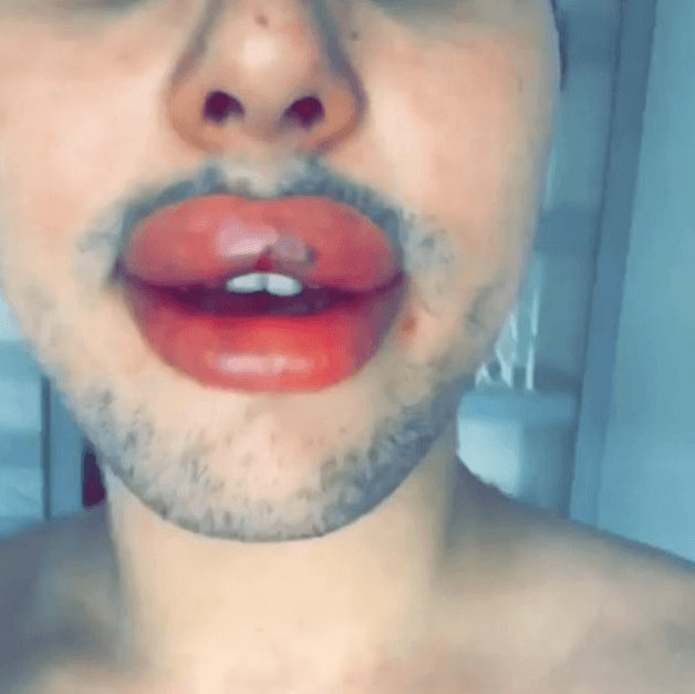 Dudakları patlama noktasına geldi! - Sayfa 6