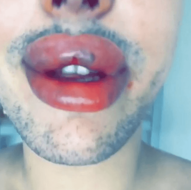 Dudakları patlama noktasına geldi! - Sayfa 7