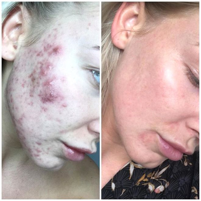 Sivilceleriyle başı dertteydi, son hali inanılmaz! - Sayfa 5