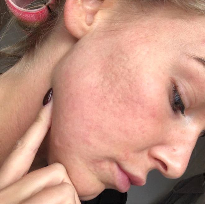 Sivilceleriyle başı dertteydi, son hali inanılmaz! - Sayfa 7