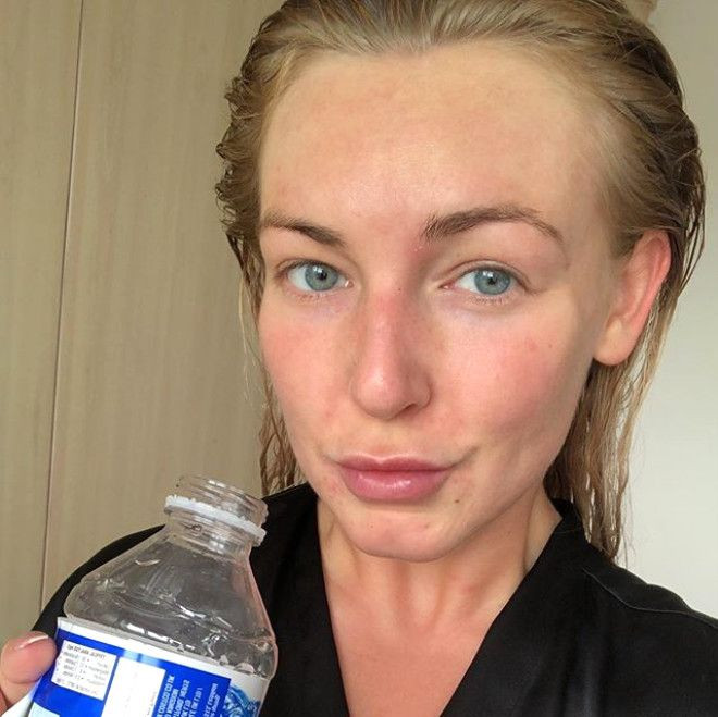 Sivilceleriyle başı dertteydi, son hali inanılmaz! - Sayfa 14