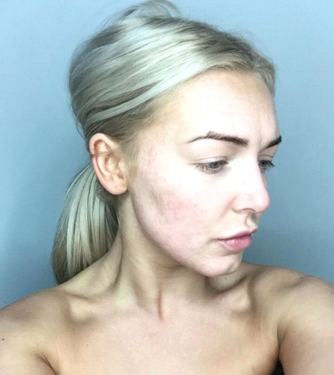 Sivilceleriyle başı dertteydi, son hali inanılmaz! - Sayfa 11