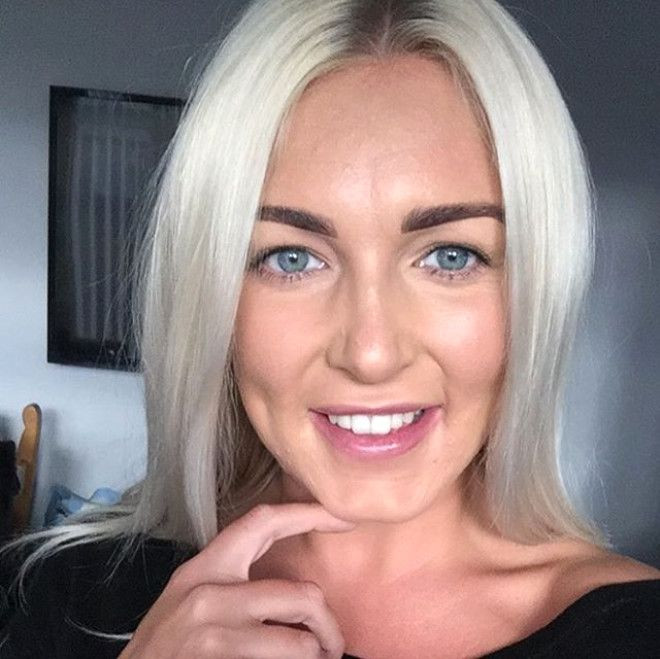 Sivilceleriyle başı dertteydi, son hali inanılmaz! - Sayfa 12