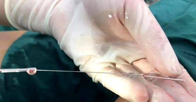 Cinsel organına 11 santimlik iğne soktu! - Sayfa 5