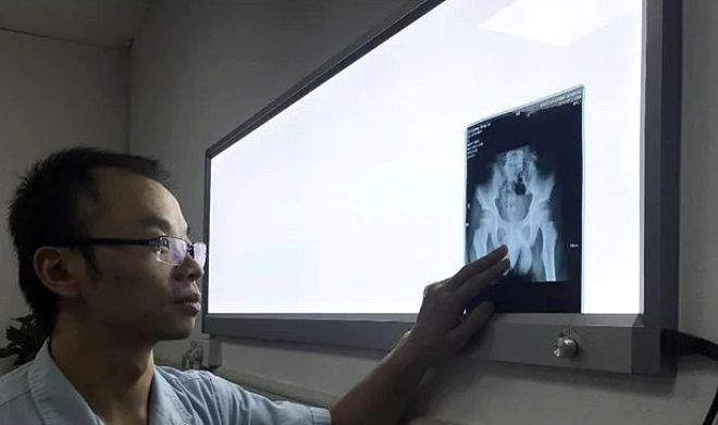 Cinsel organına 11 santimlik iğne soktu! - Sayfa 6