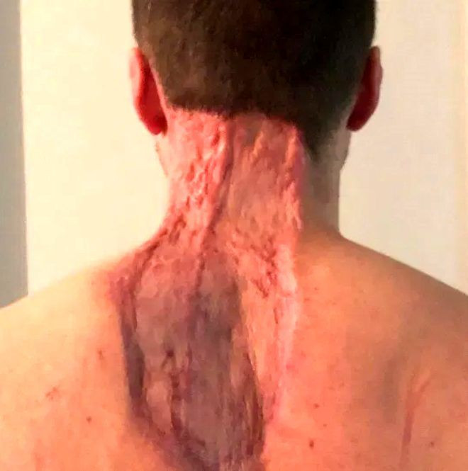 Minicik bir ben sırtının yarısını götürdü! - Sayfa 5