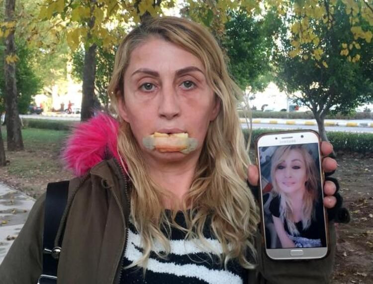 Güzellik uğruna alt dudağını kaybetti! Kötü haber geldi... - Sayfa 9