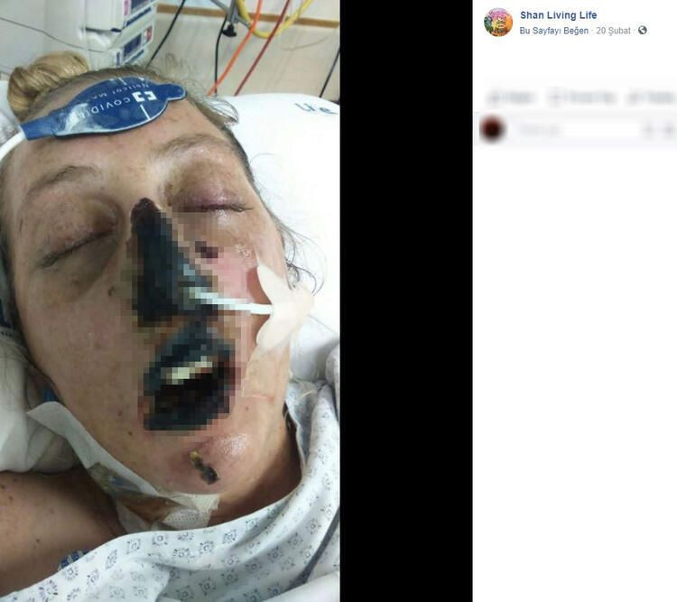 Bir ısırık 66 ameliyat! Hayatı karardı... - Sayfa 10