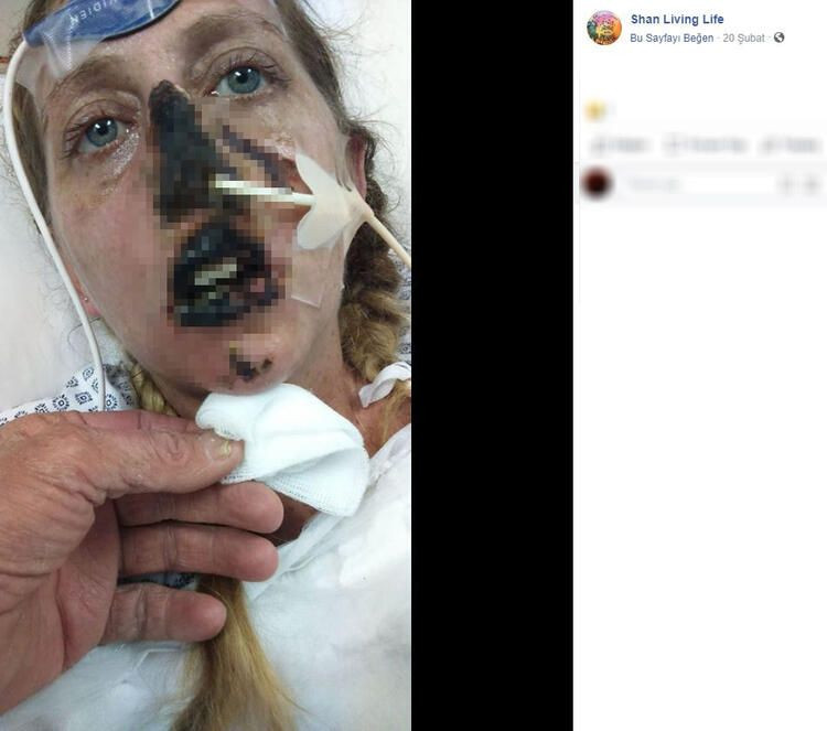 Bir ısırık 66 ameliyat! Hayatı karardı... - Sayfa 11