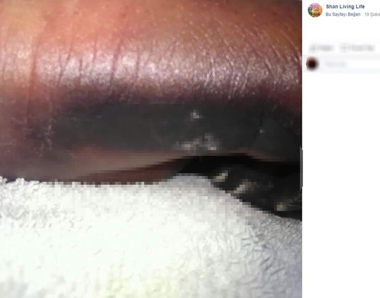 Bir ısırık 66 ameliyat! Hayatı karardı... - Sayfa 13