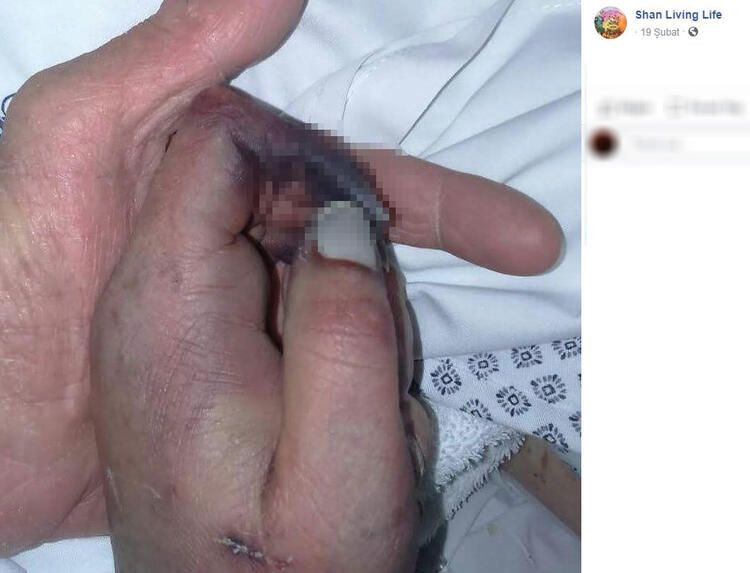 Bir ısırık 66 ameliyat! Hayatı karardı... - Sayfa 14