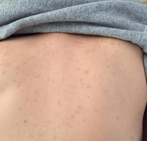 210 hastanın deri bulguları incelendi - Sayfa 6