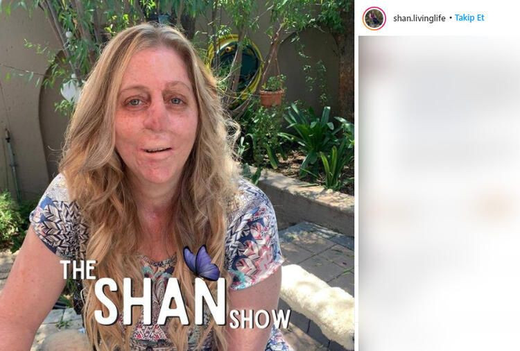 Fare ısırdı hayatı kabusa döndü! Burnu, dudakları, bacakları ve kolları kesildi... - Sayfa 8