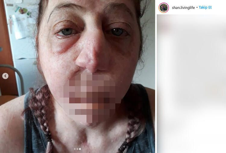 Fare ısırdı hayatı kabusa döndü! Burnu, dudakları, bacakları ve kolları kesildi... - Sayfa 6