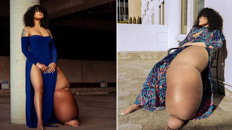 Bacaklarından biri 45 kilo! Fil hastalığı olan genç kadın kendiyle barışmayı öğrendi... - Sayfa 10