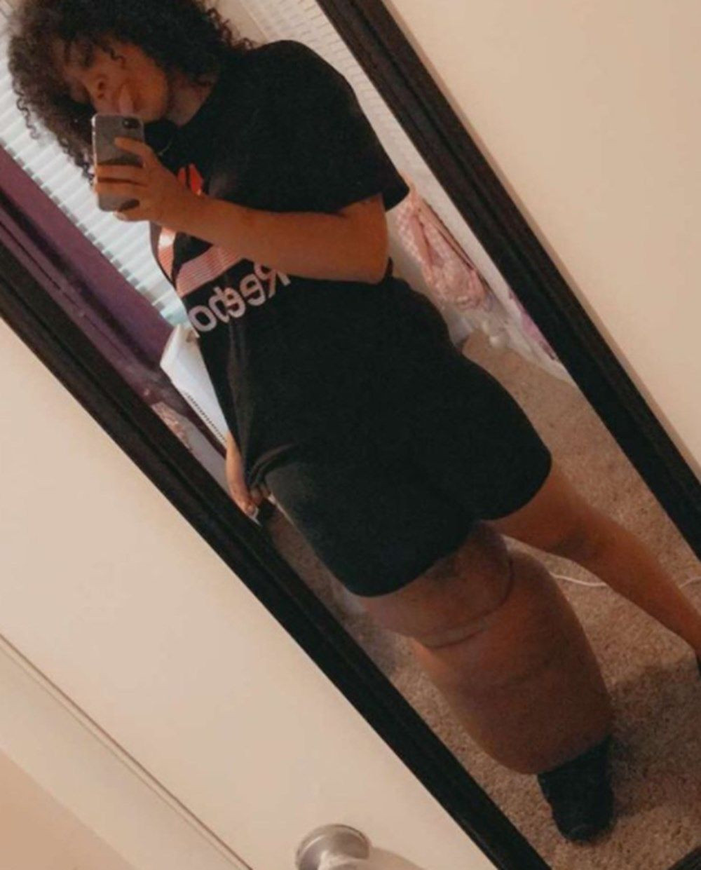 Bacaklarından biri 45 kilo! Fil hastalığı olan genç kadın kendiyle barışmayı öğrendi... - Sayfa 5