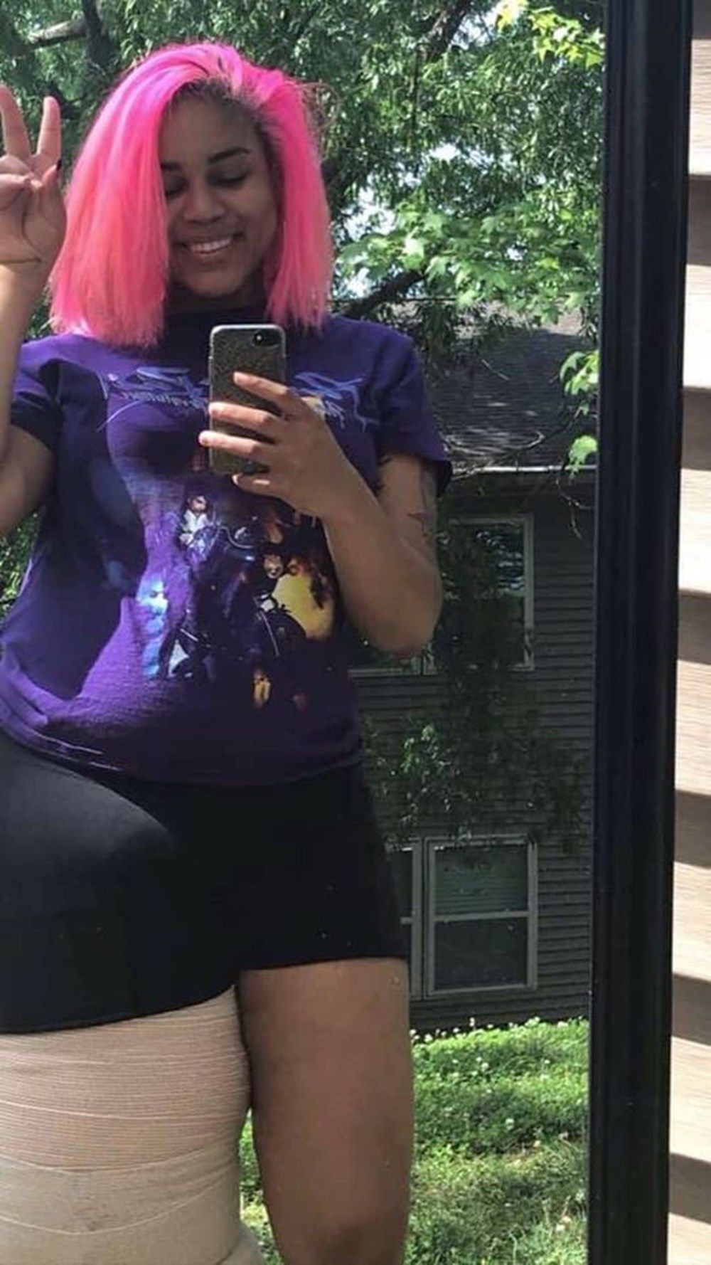 Bacaklarından biri 45 kilo! Fil hastalığı olan genç kadın kendiyle barışmayı öğrendi... - Sayfa 7