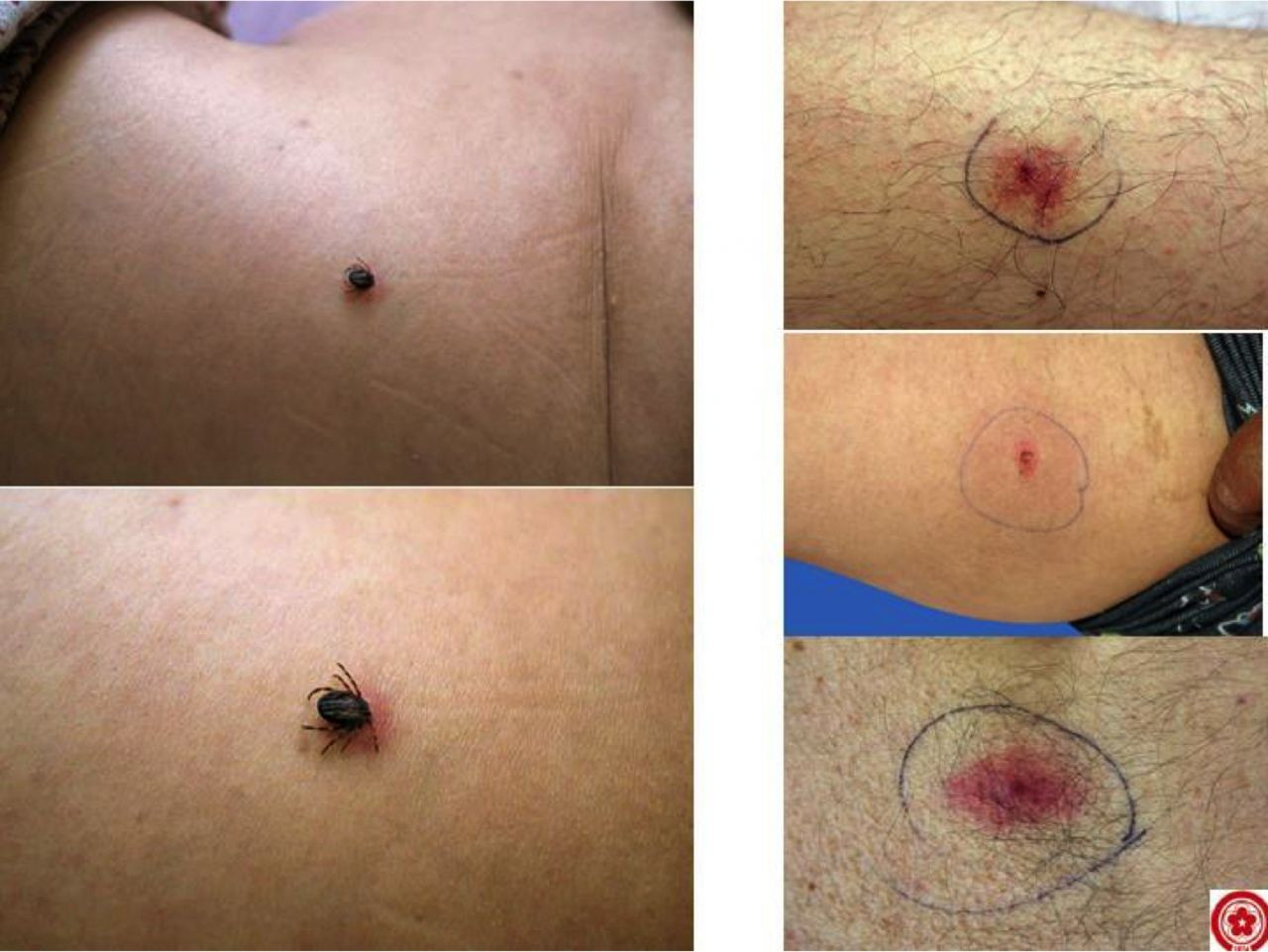 Bunu sakın yapmayın! Kene ısırıklarında hayati önem taşıyor - Sayfa 7