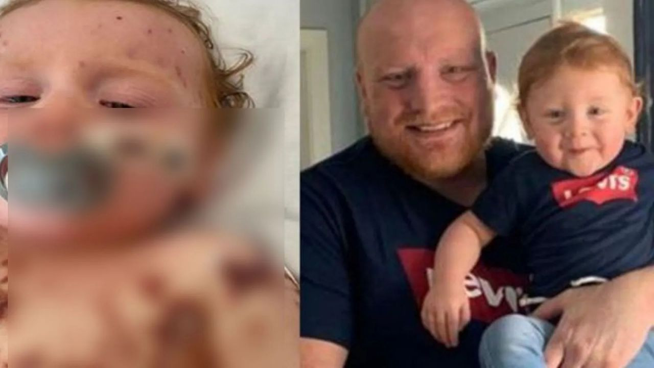 Annesi kızamık zannetti, gerçek bambaşka çıktı: Parmaklarını kaybedebilir! - Sayfa 5