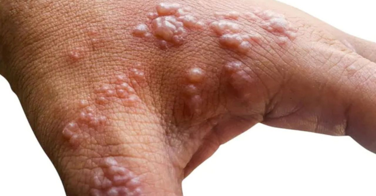 DSÖ, maymun çiçeği virüsünün ismini değiştiriyor! İşte sebebi - Sayfa 7