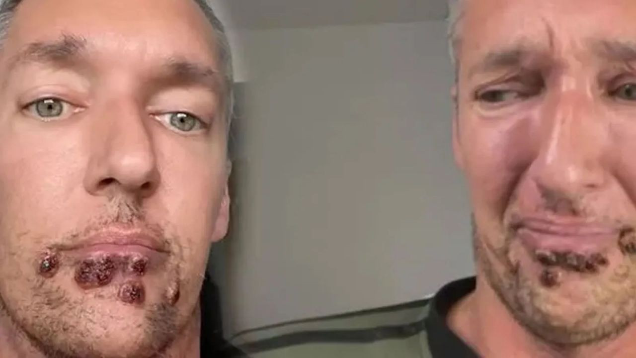 Burnunda ve cinsel organında çıkan kırmızı nokta hayatını kabusa çevirdi! 3 günde tanınmaz hale geldi... - Sayfa 5