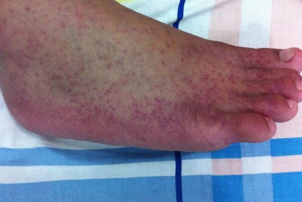 Yeni salgın alarmı: Domates gribi! Özellikle çocukları etkiliyor... İşte belirtileri... - Sayfa 5