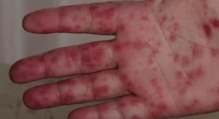 Yeni salgın alarmı: Domates gribi! Özellikle çocukları etkiliyor... İşte belirtileri... - Sayfa 6