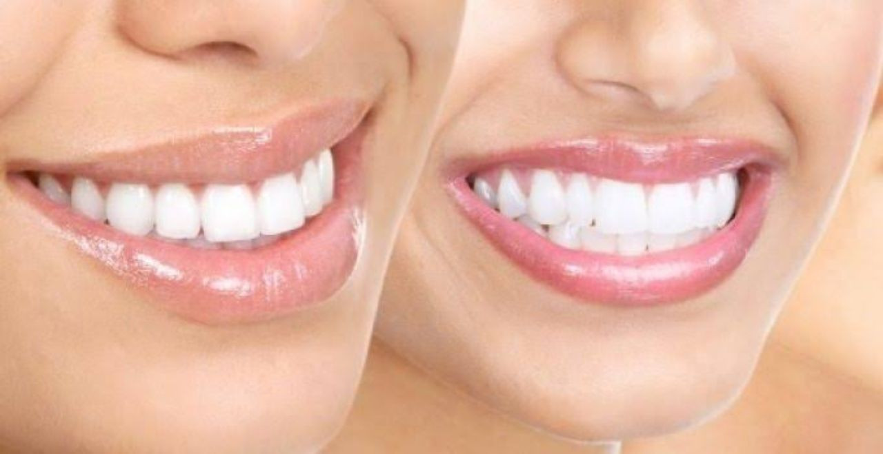 Porselen diş yaptıracaklar dikkat! Dişlerinizi kökten kaybedebilirsiniz - Sayfa 6