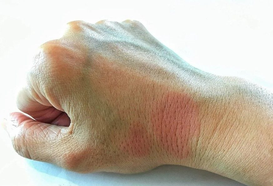 Dilan Polat'ın hastalığı Lupus hastalığı hakkında merak edilenler! - Sayfa 5