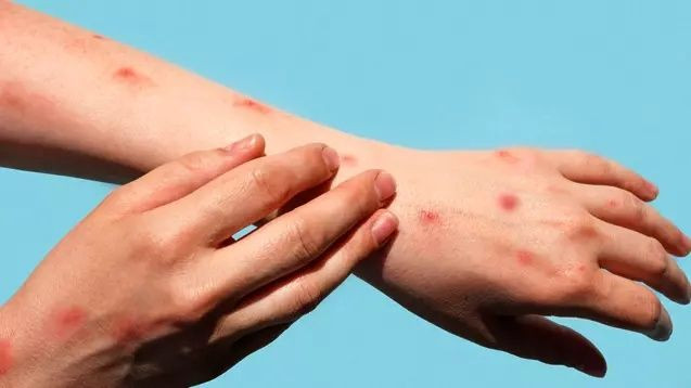 Afrika'da başlayıp Avrupa'da görülen Maymun Çiçeği virüsü Asya'ya sıçradı! Pakistan'da tespit edildi... - Sayfa 11