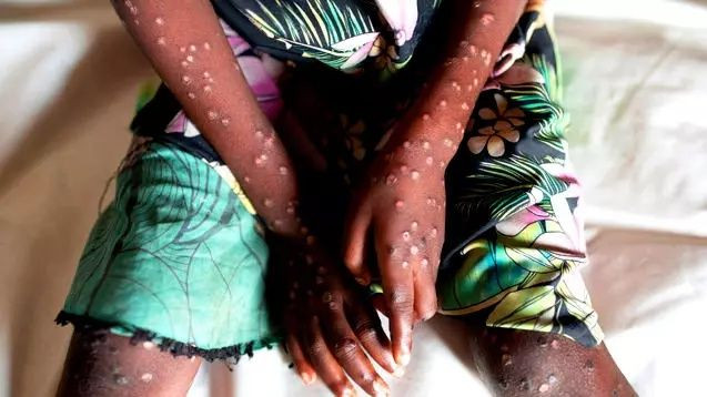 Afrika'da başlayıp Avrupa'da görülen Maymun Çiçeği virüsü Asya'ya sıçradı! Pakistan'da tespit edildi... - Sayfa 10