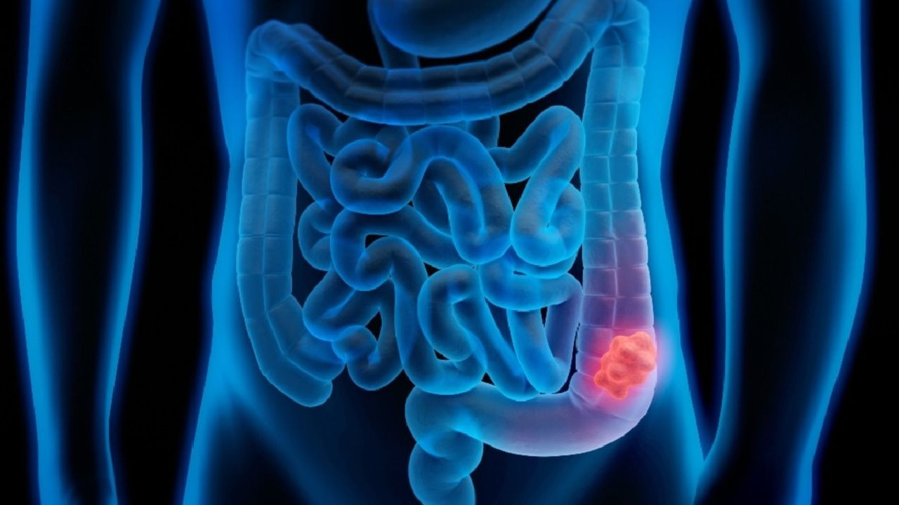 Yoğurt mucizesi: Bağırsak kanserine karşı koruyucu kalkan! İşte etkisi... - Sayfa 4